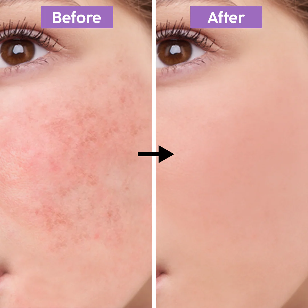 Teashell Niacinamide Brightening Serum | Fade Dark Spots, Acne Marks & Even Skin Tone