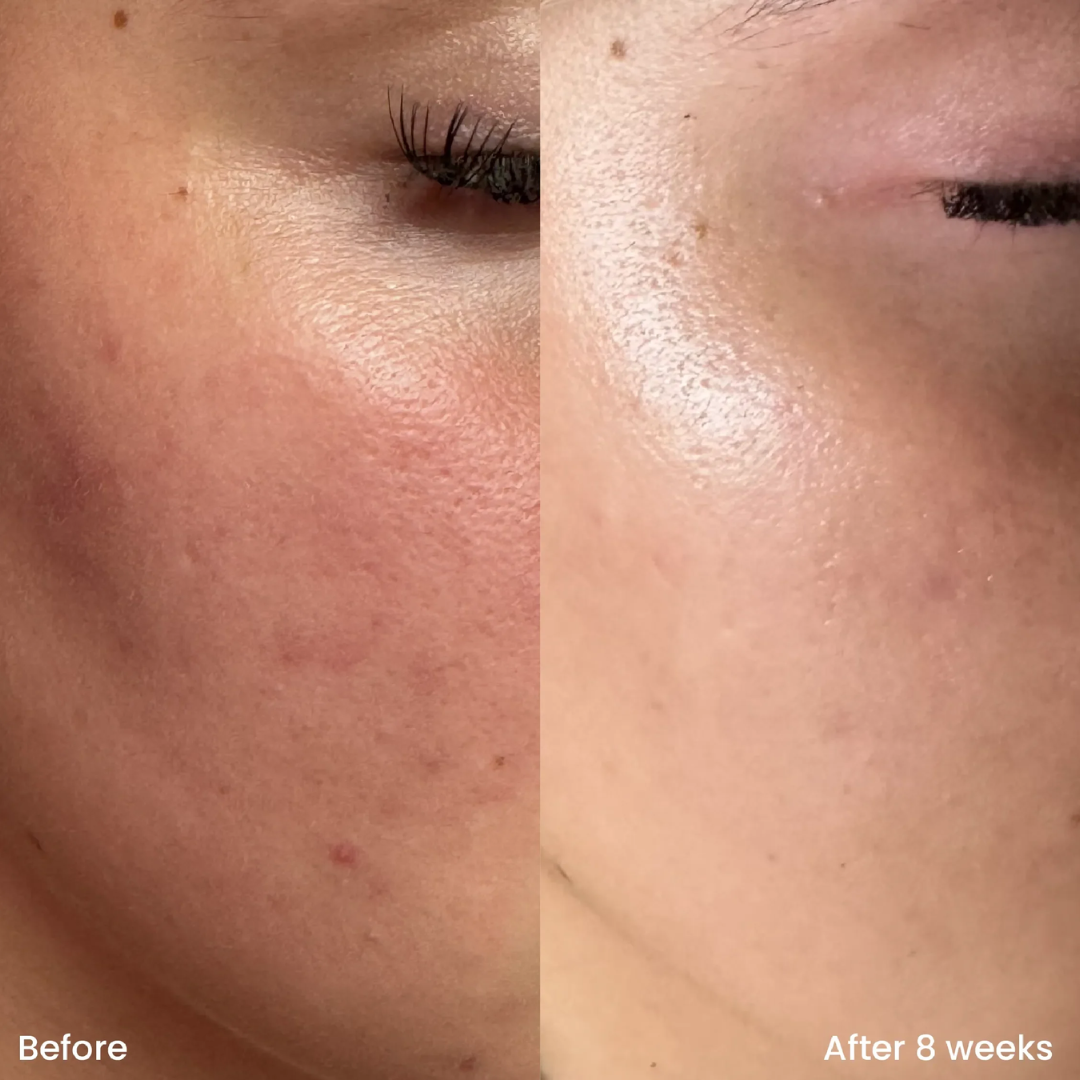 Teashell Niacinamide Brightening Serum | Fade Dark Spots, Acne Marks & Even Skin Tone