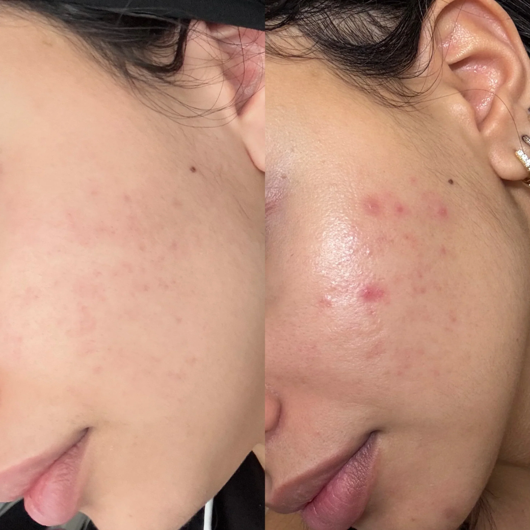 Teashell Niacinamide Brightening Serum | Fade Dark Spots, Acne Marks & Even Skin Tone