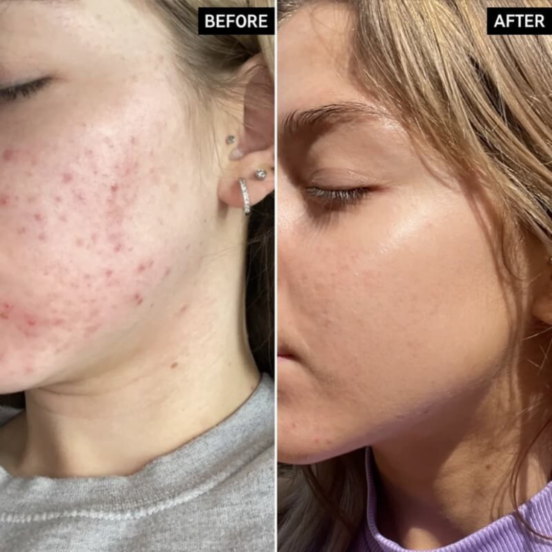 Teashell Niacinamide Brightening Serum | Fade Dark Spots, Acne Marks & Even Skin Tone